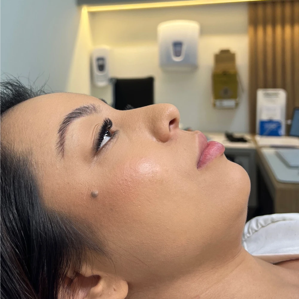 Perfil lateral de uma paciente antes da perfiloplastia, mostrando nariz, lábios e queixo