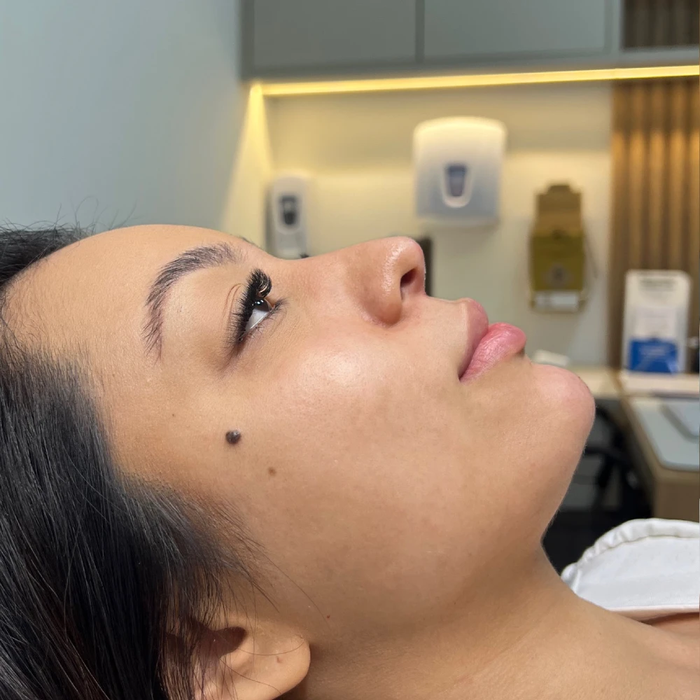 Perfil lateral da mesma paciente depois da perfiloplastia, mostrando nariz, lábios e queixo