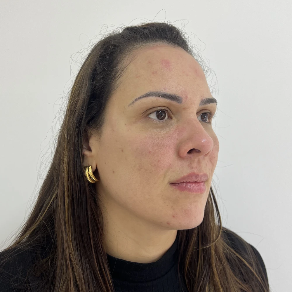 Rosto da mesma paciente em vista de três quartos depois do preenchimento facial
